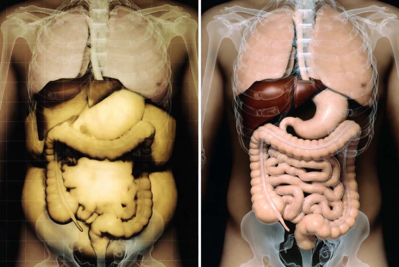 Targeting the Fat That Matters Most: Visceral vs. Subcutaneous