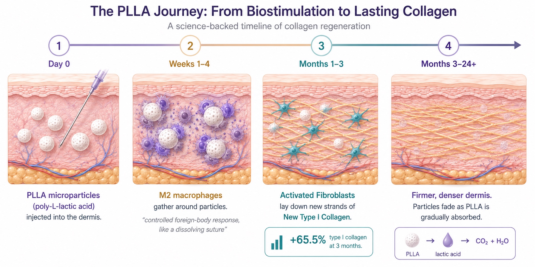 How Poly-L-Lactic Acid Builds New Collagen Over Months